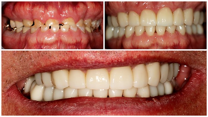 Best veneers teeth in Surat